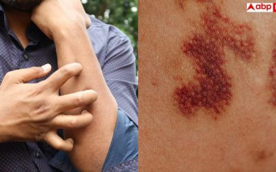 Blood Most cancers Signs: If crimson rashes are constantly seen on the pores and skin then get CBC finished instantly, it could be blood most cancers.
[/gpt3]