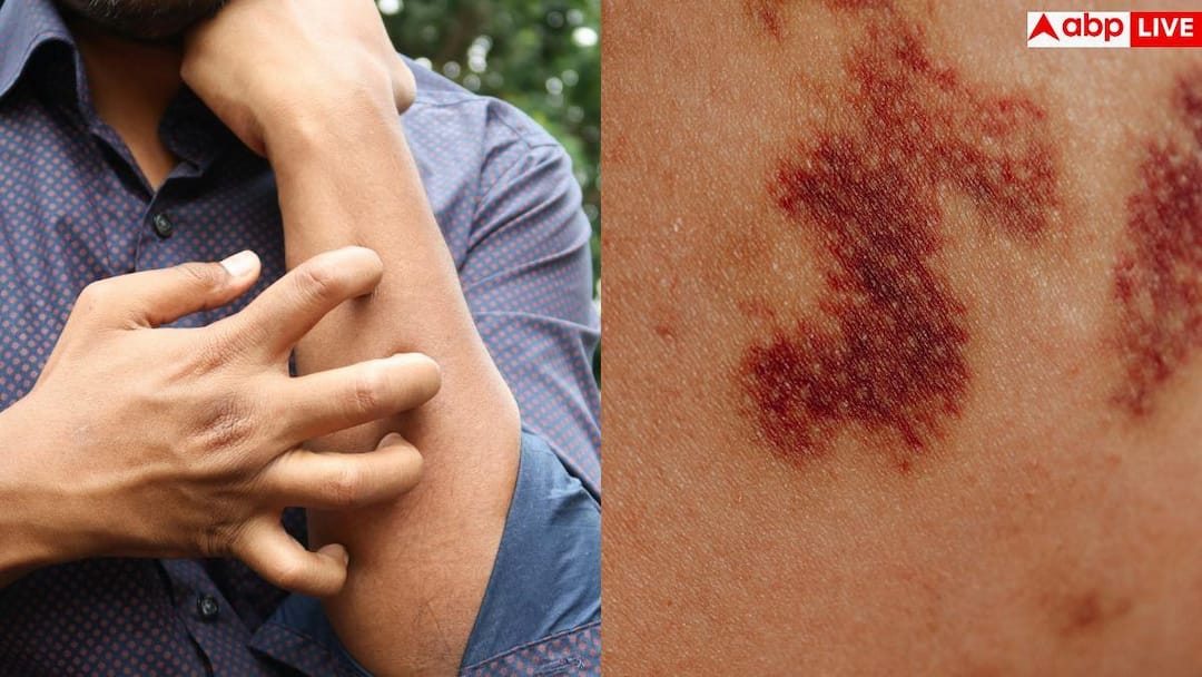 Blood Most cancers Signs: If crimson rashes are constantly seen on the pores and skin then get CBC finished instantly, it could be blood most cancers.
[/gpt3]
